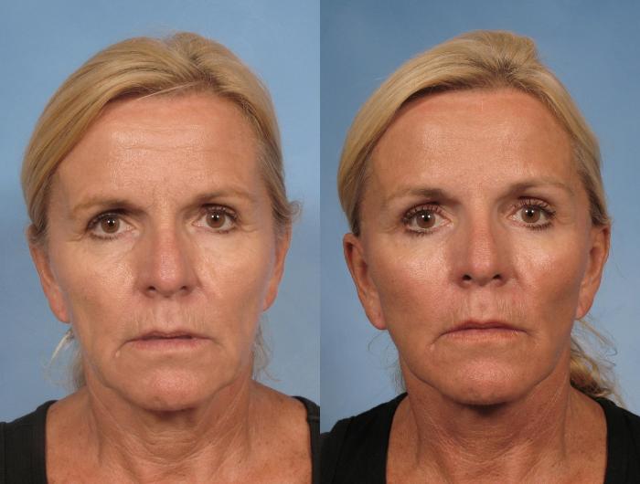 Before & After Eyelid Lift (Blepharoplasty) Case 106 View #1 View in Naples and Ft. Myers, FL