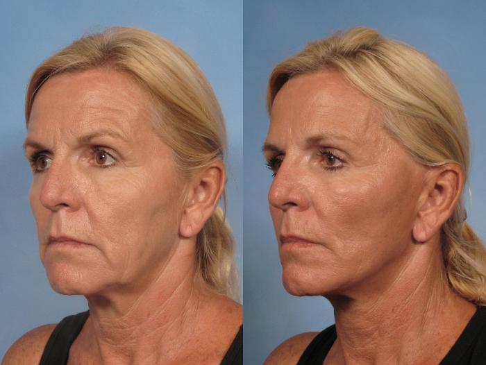 Before & After Eyelid Lift (Blepharoplasty) Case 106 View #2 View in Naples and Ft. Myers, FL