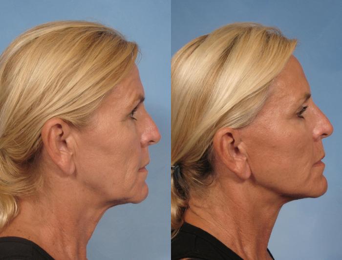 Before & After Eyelid Lift (Blepharoplasty) Case 106 View #3 View in Naples and Ft. Myers, FL