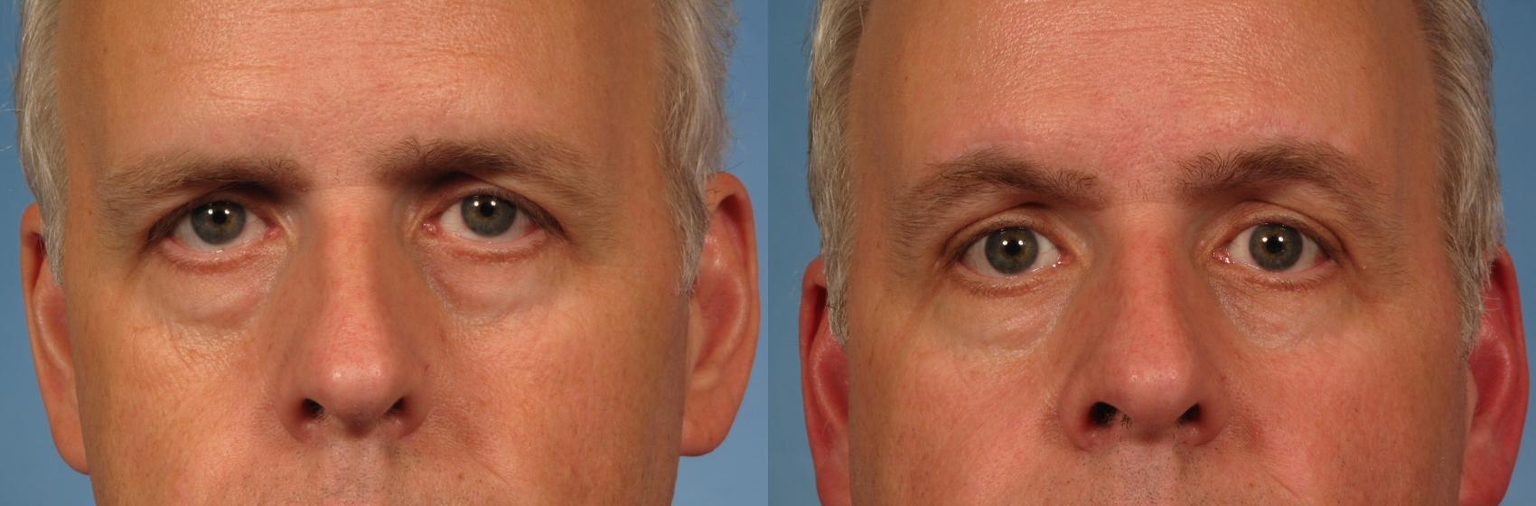 Before & After Eyelid Lift (Blepharoplasty) Case 175 View #1 View in Naples and Ft. Myers, FL