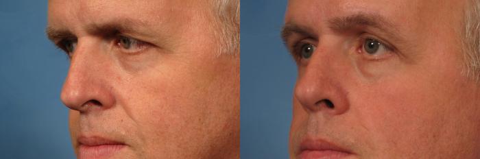 Before & After Eyelid Lift (Blepharoplasty) Case 175 View #2 View in Naples and Ft. Myers, FL