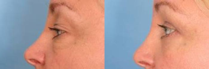 Before & After Eyelid Lift (Blepharoplasty) Case 18 View #1 View in Naples and Ft. Myers, FL