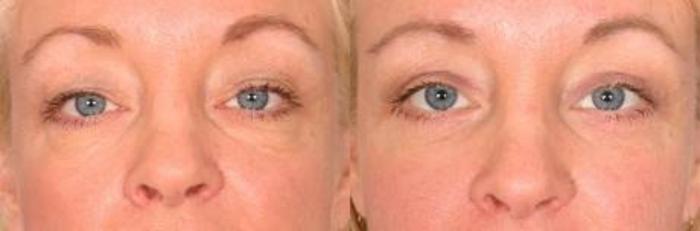 Before & After Eyelid Lift (Blepharoplasty) Case 18 View #3 View in Naples and Ft. Myers, FL