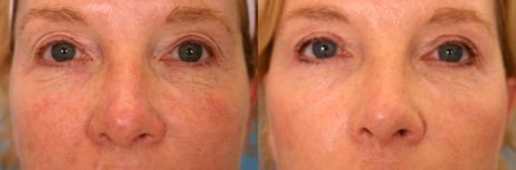 Before & After Eyelid Lift (Blepharoplasty) Case 19 View #1 View in Naples and Ft. Myers, FL