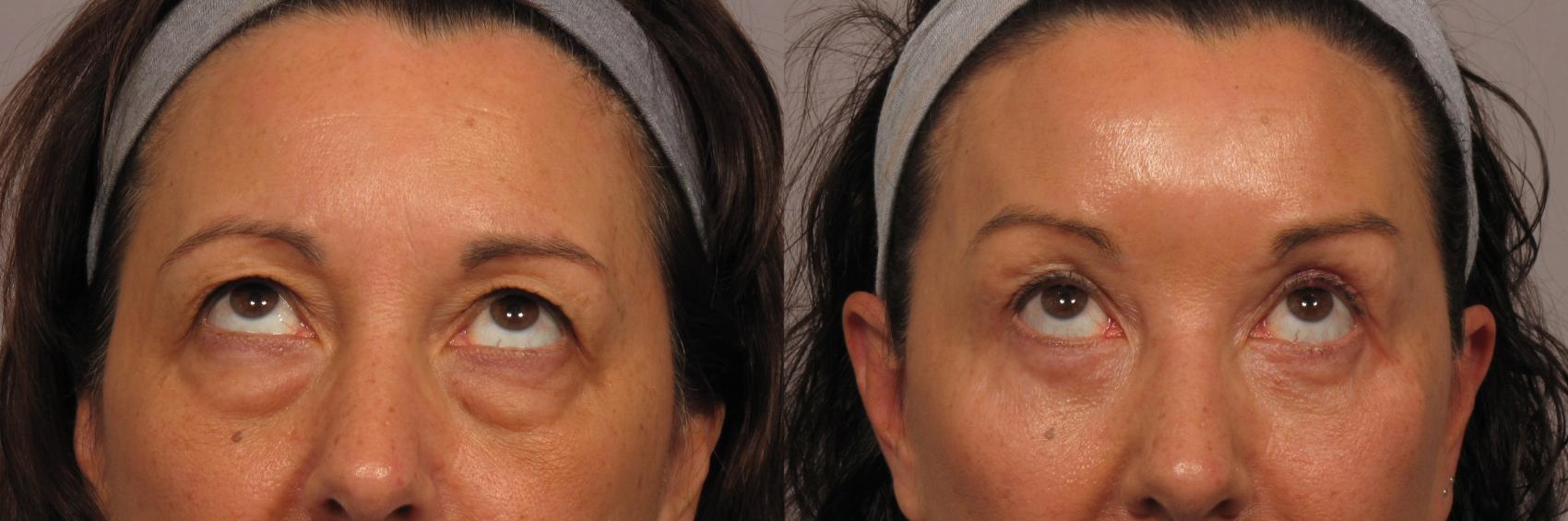 Front View of Eye and Brow Lift with Patient looking up