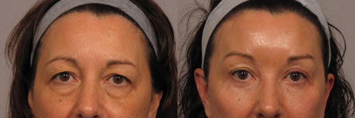 Front View of Patient who underwent eyelid lift and brow lift