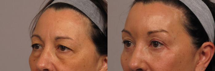 Eye lid Lift, Brow Lift Left Oblique View Before and 9 Months After