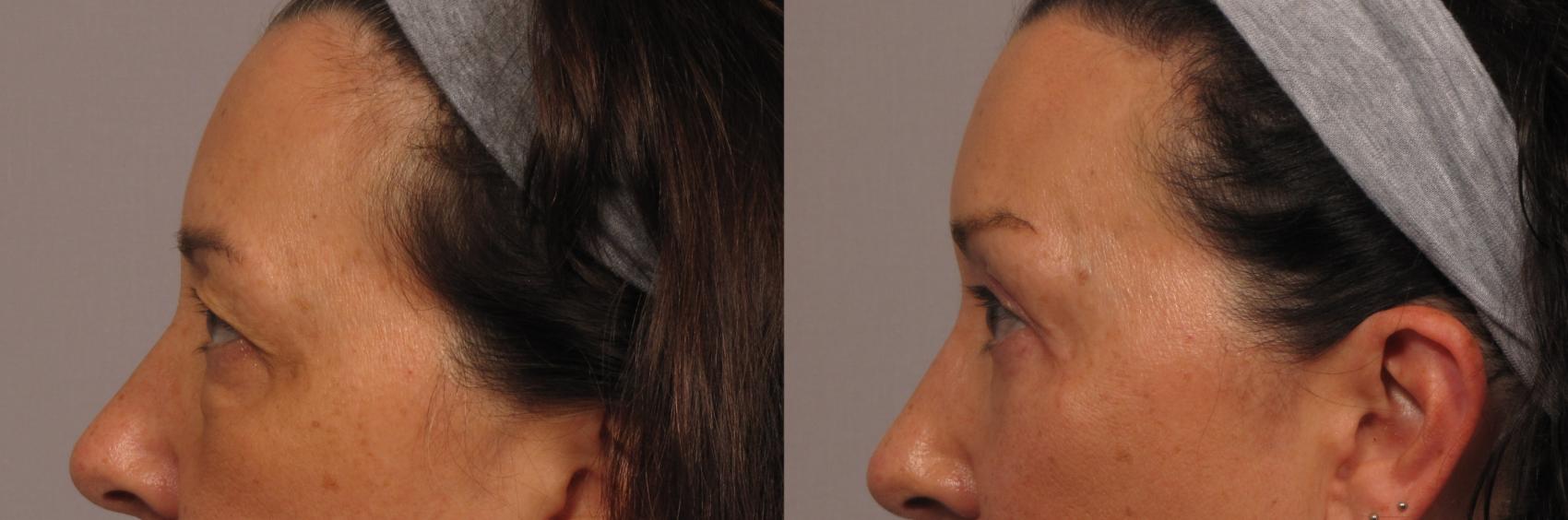 Left Side view of Eye and Brow lift patient 9 months after surgery