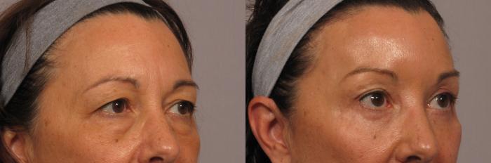 Eye lid and Brow Lift, Right Oblique View, Before and After