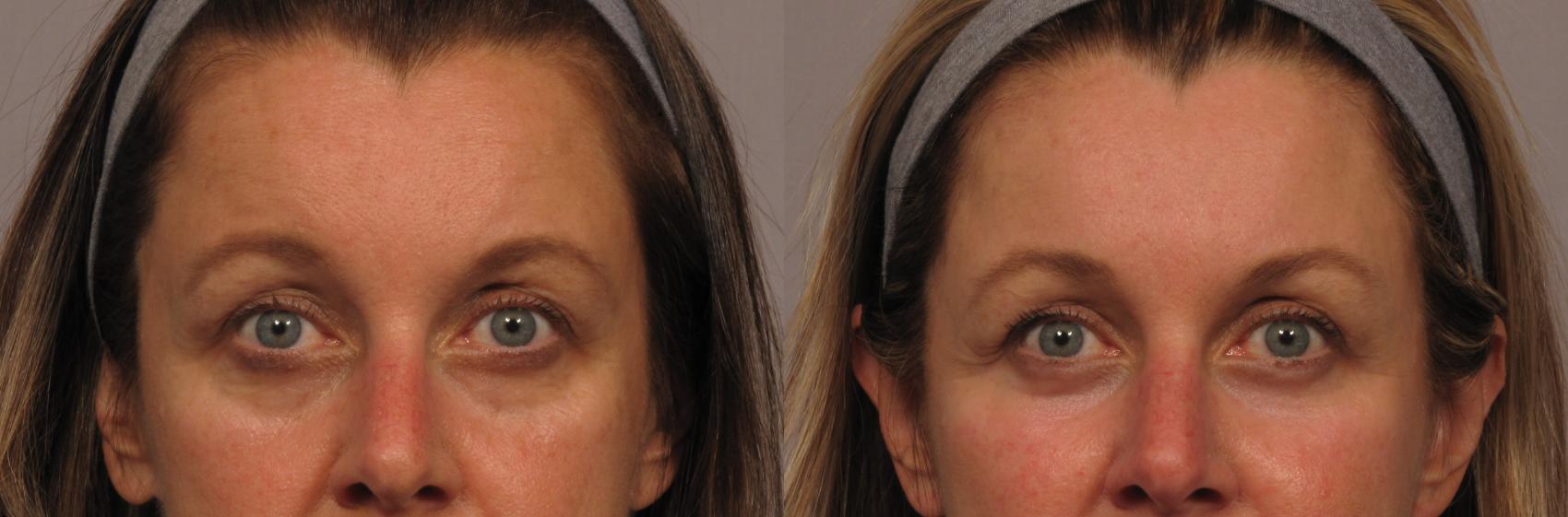 Eyelid Surgery Fort Myers - Upper & Lower Lid Blepharoplasty