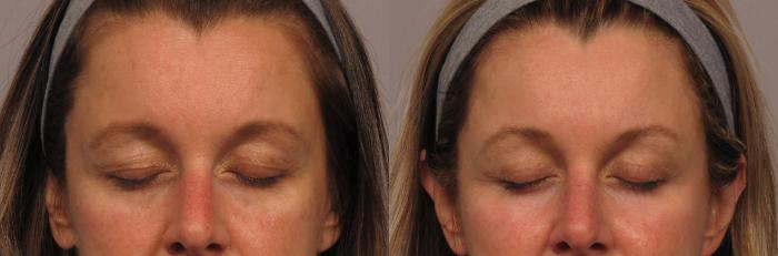 Eyelid and Brow Lift, Front View with Eyes Shut, Before and 6 Months After