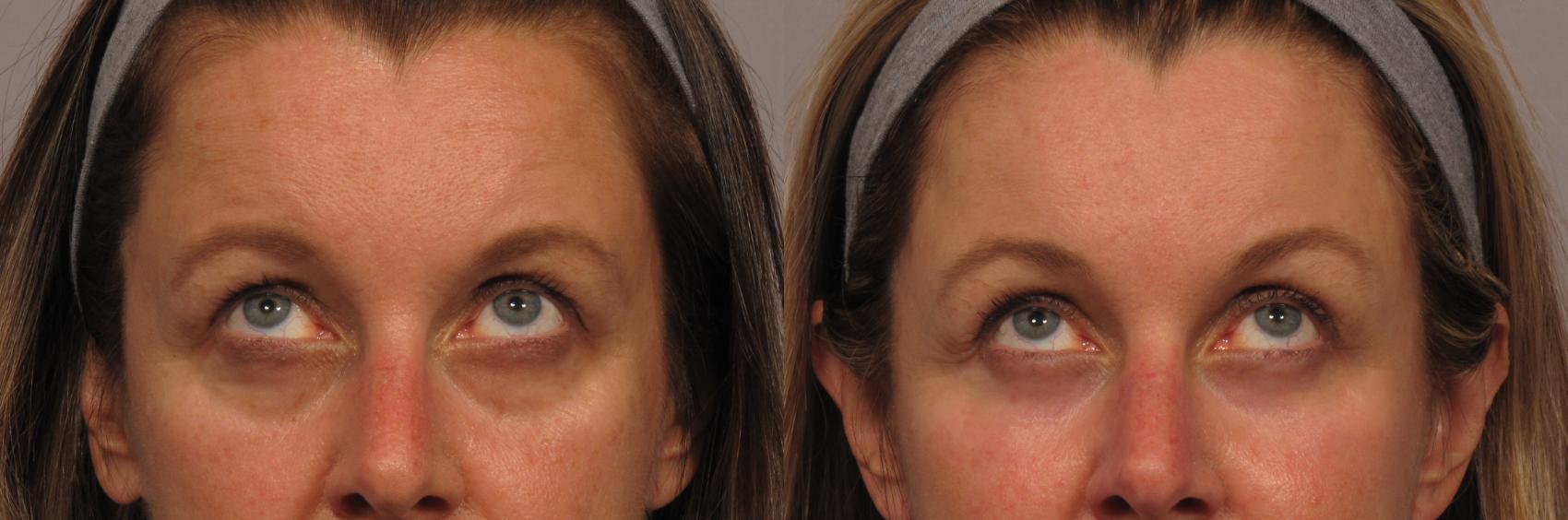 Eyelid and Brow Lift Before and After, Front View Looking up