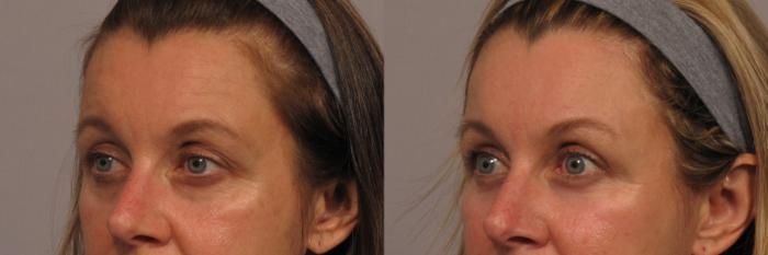 Before and 6 Months After Eye lid Lift and Brow Lift, Left Oblique View