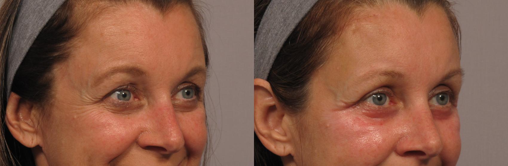Before and 3 Weeks After Eye lid Lift and Brow Lift, Right Oblique - Smiling View