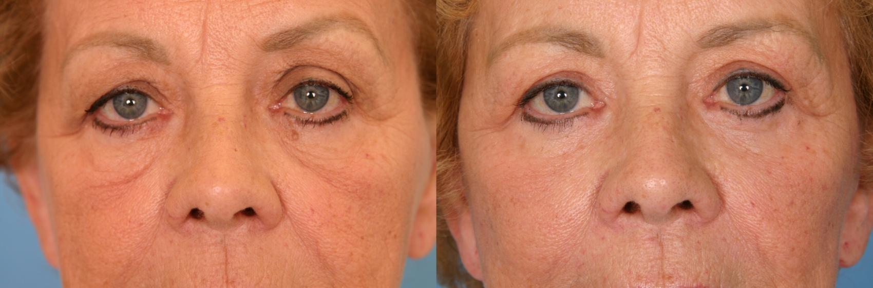 Before & After Eyelid Lift (Blepharoplasty) Case 52 View #1 View in Naples and Ft. Myers, FL