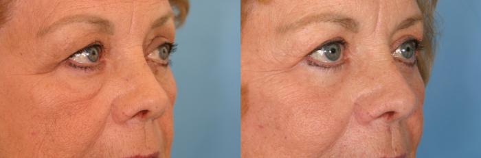 Before & After Eyelid Lift (Blepharoplasty) Case 52 View #2 View in Naples and Ft. Myers, FL