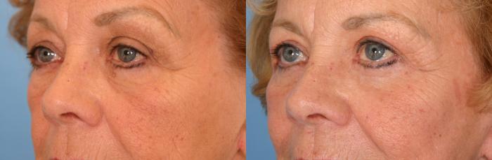 Before & After Eyelid Lift (Blepharoplasty) Case 52 View #3 View in Naples and Ft. Myers, FL