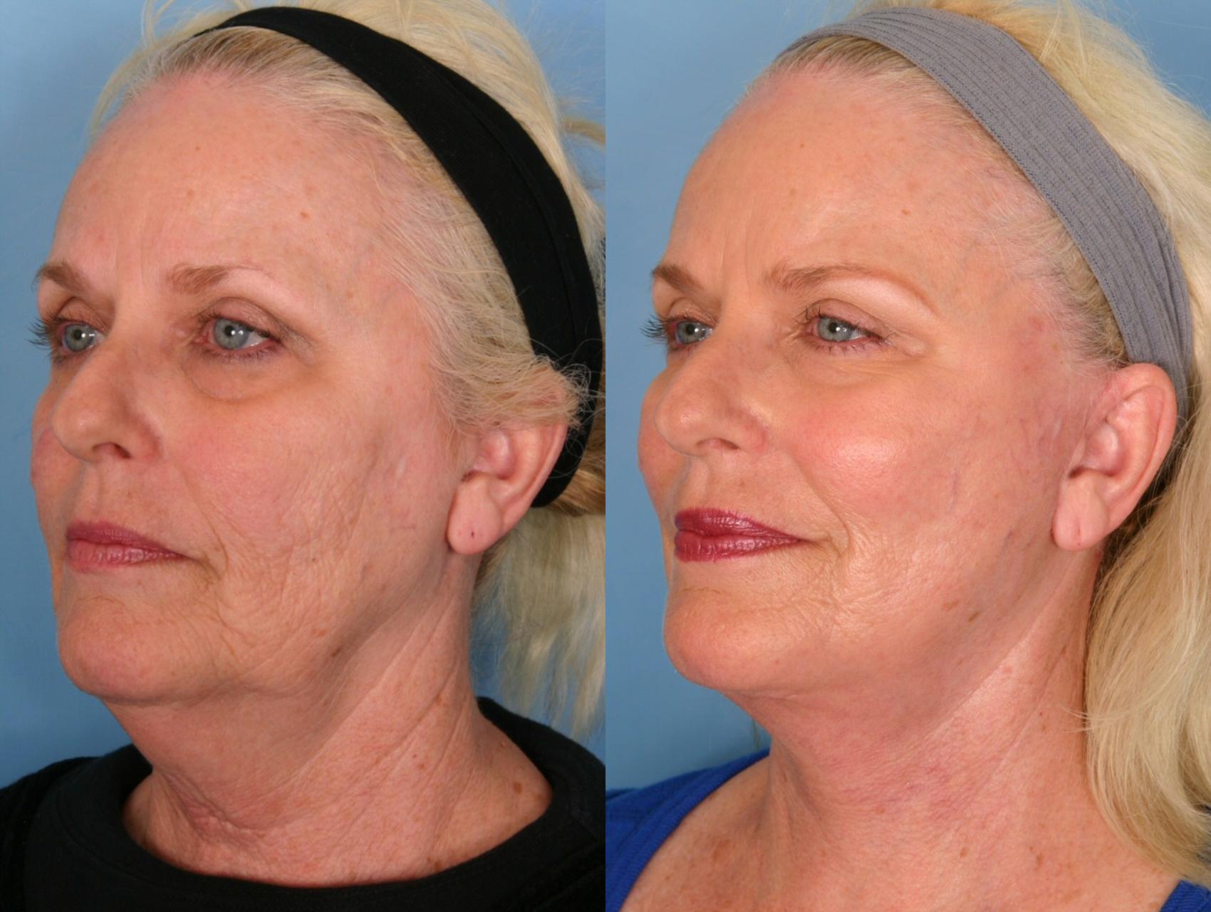 Before & After Facelift Case 10 View #3 View in Naples, FL