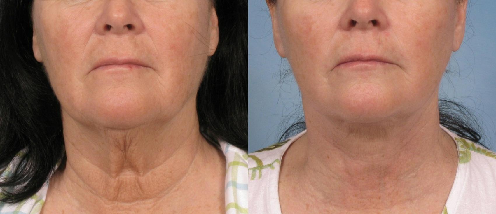Before & After Facelift Case 109 View #1 View in Naples, FL
