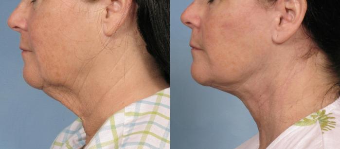 Before & After Facelift Case 109 View #2 View in Naples and Ft. Myers, FL