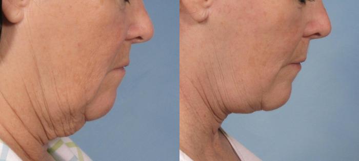 Before & After Facelift Case 109 View #3 View in Naples and Ft. Myers, FL