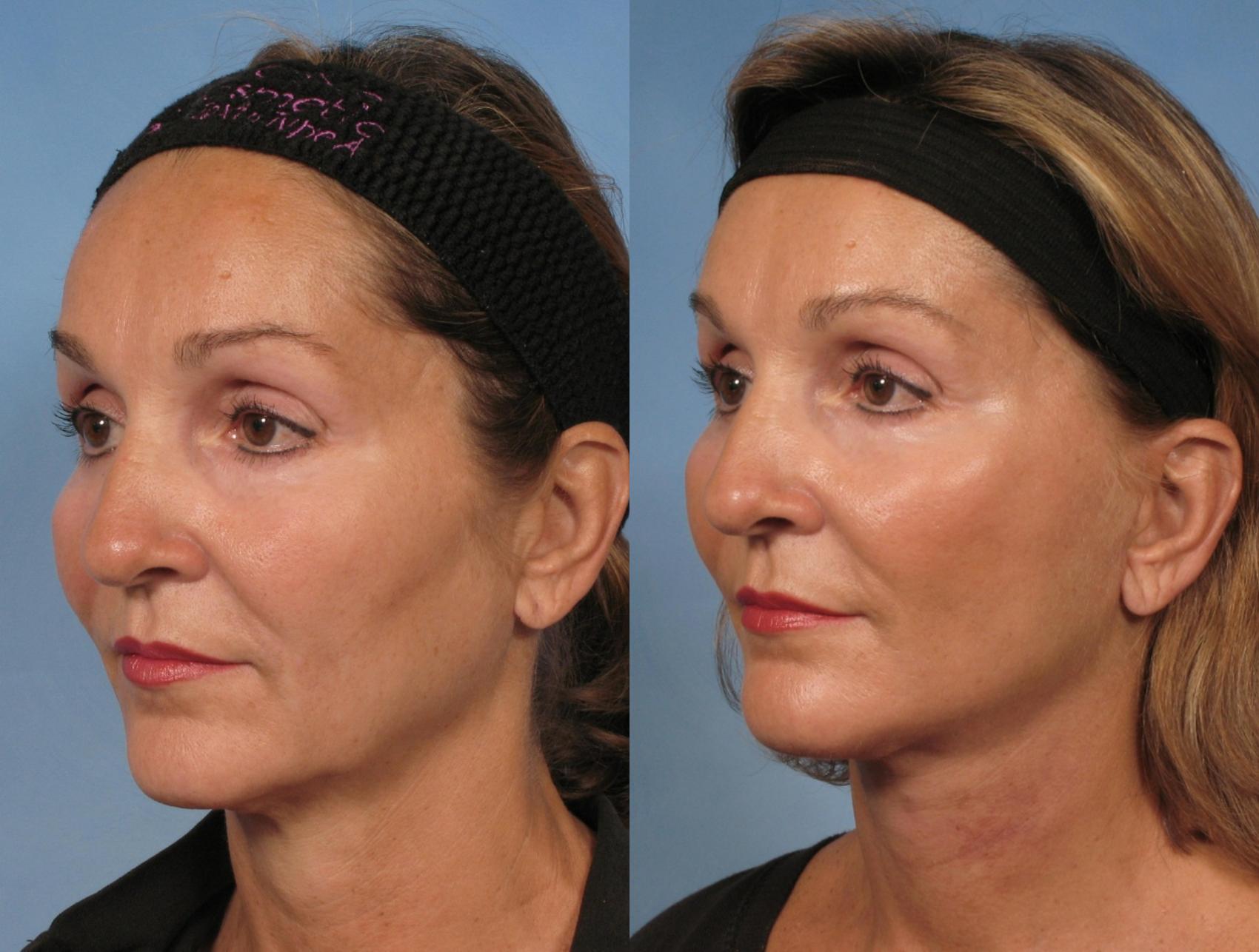 Before & After Facelift Case 110 View #1 View in Naples and Ft. Myers, FL