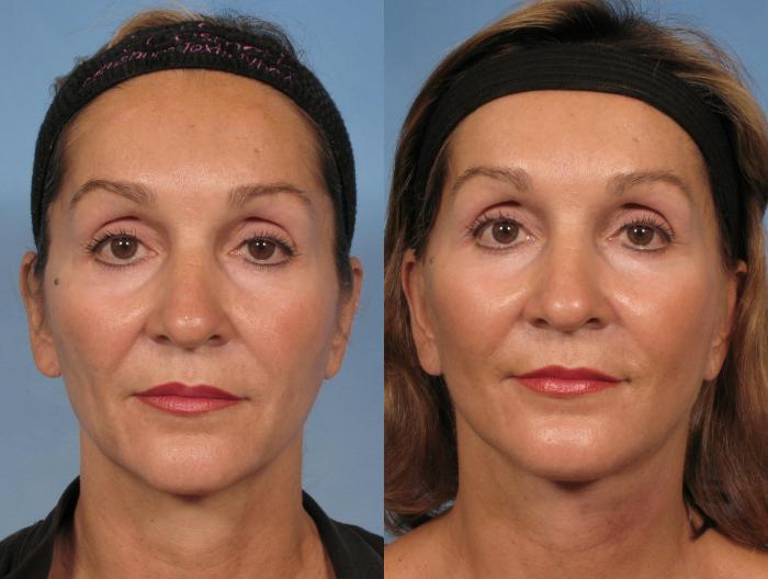 Before & After Facelift Case 110 View #2 View in Naples and Ft. Myers, FL