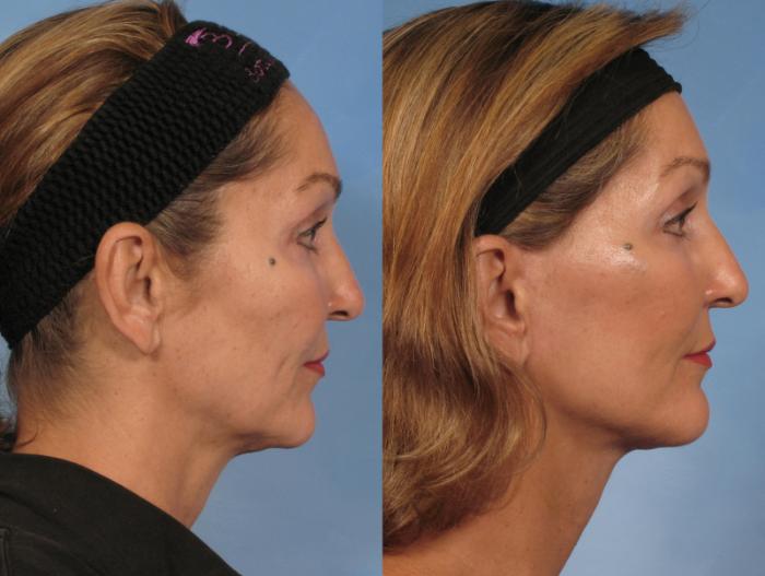 Before & After Facelift Case 110 View #3 View in Naples and Ft. Myers, FL