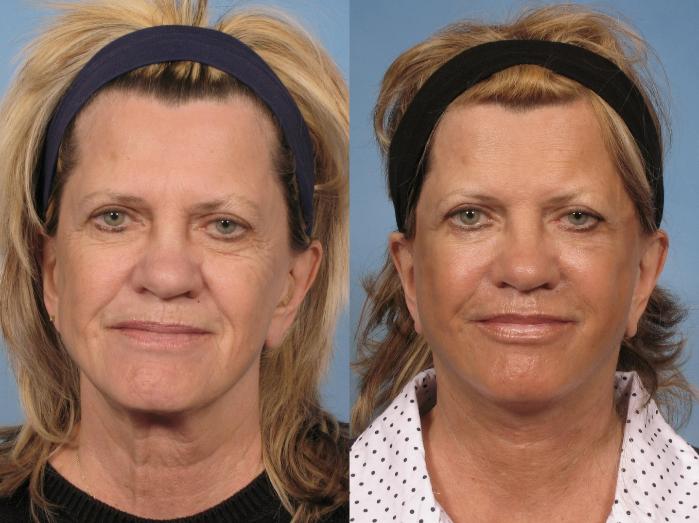 Before & After Facelift Case 111 View #1 View in Naples and Ft. Myers, FL