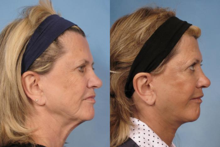 Before & After Facelift Case 111 View #2 View in Naples and Ft. Myers, FL