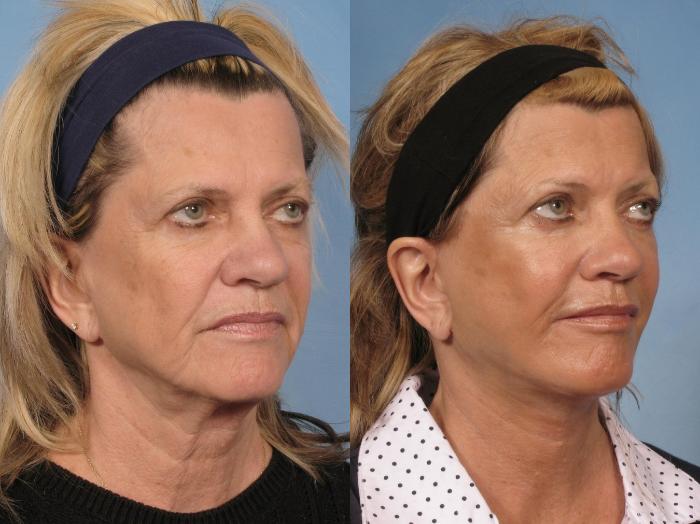 Before & After Facelift Case 111 View #3 View in Naples and Ft. Myers, FL