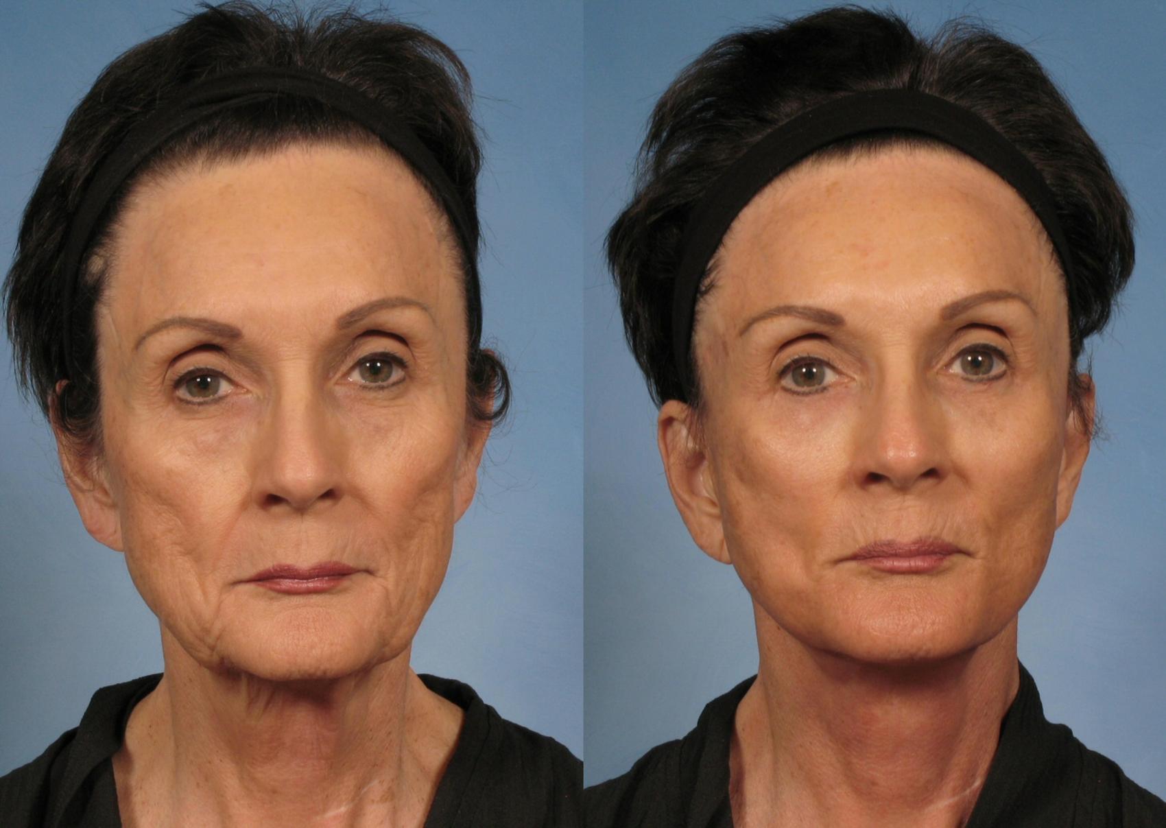 Before & After Facelift Case 142 View #1 View in Naples, FL