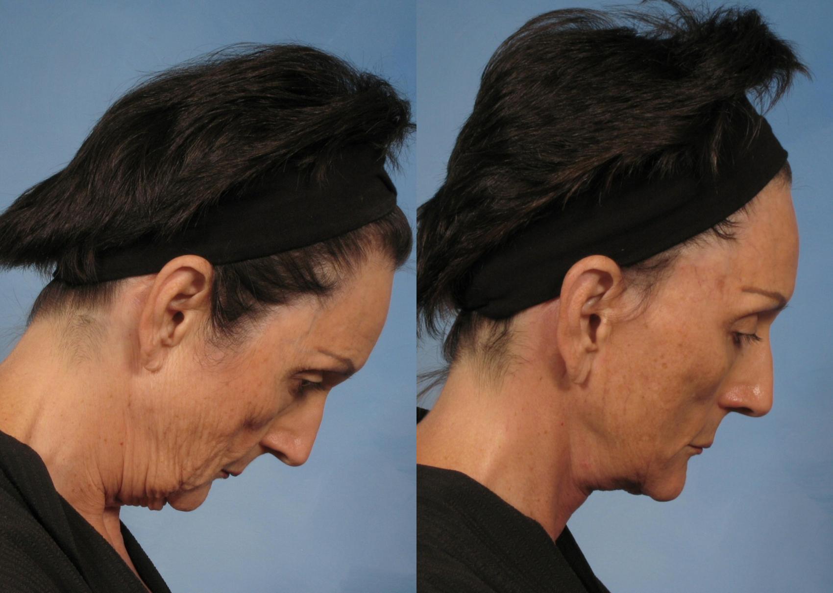 Facelift Before And After Pictures Case 142 Naples And Ft Myers Fl