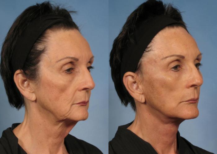Before & After Facelift Case 142 View #4 View in Naples and Ft. Myers, FL