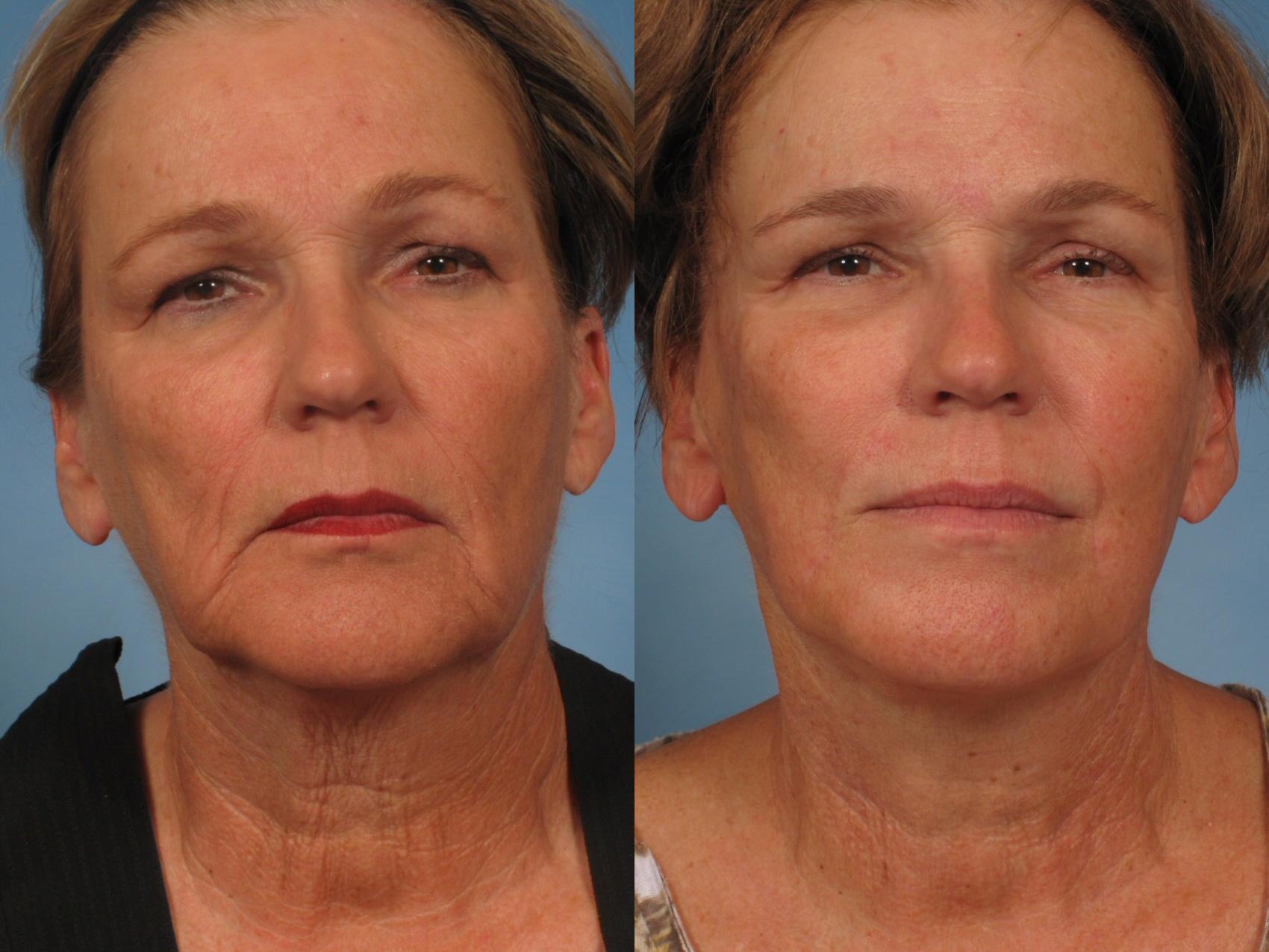 Before & After Facelift Case 165 View #4 View in Naples and Ft. Myers, FL