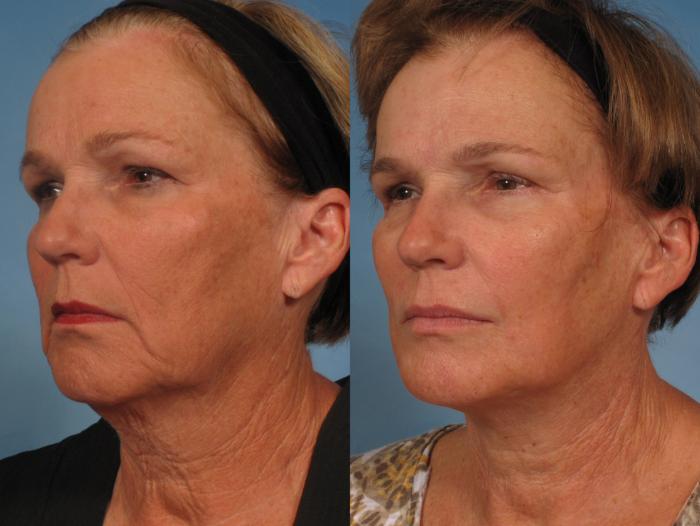 Before & After Facelift Case 165 View #5 View in Naples and Ft. Myers, FL