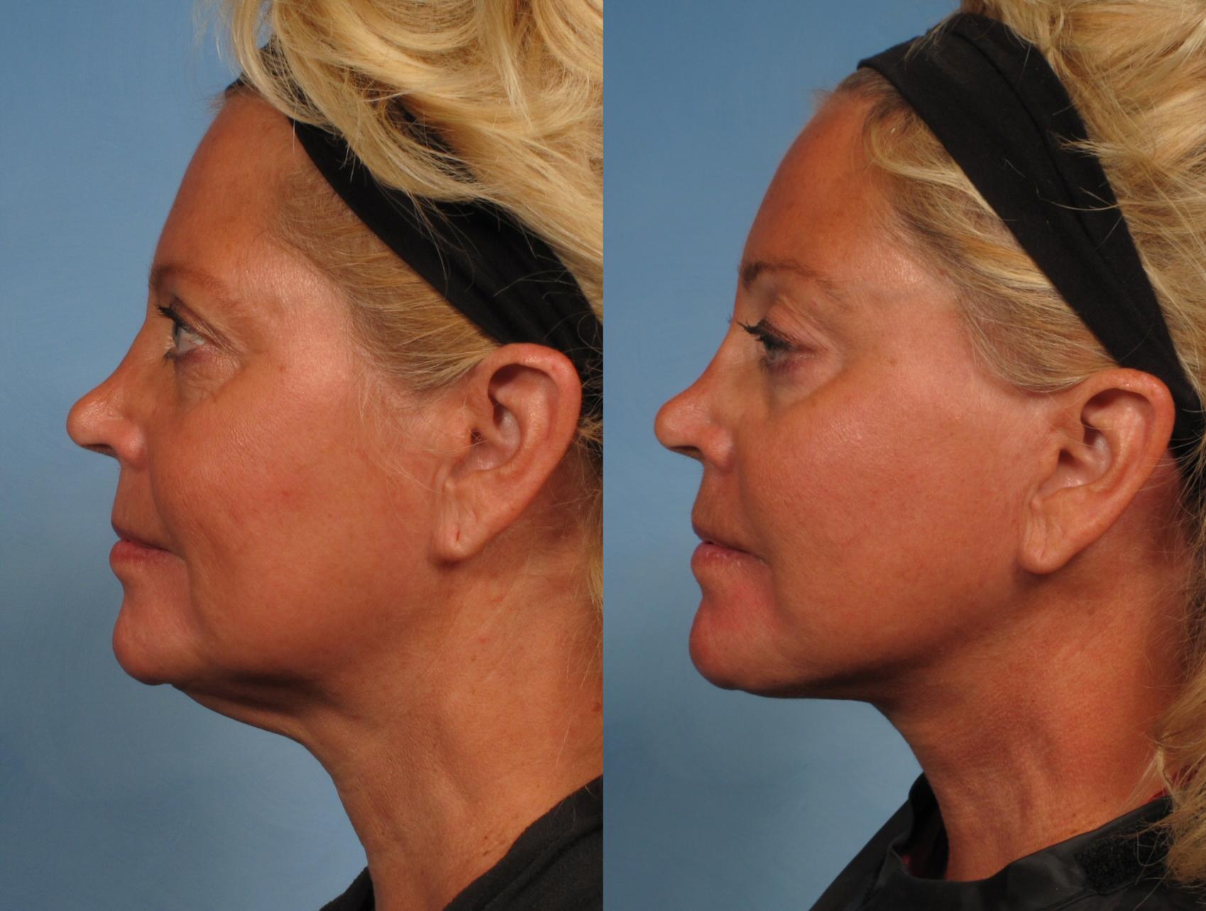 Before & After Facelift Case 166 View #1 View in Naples and Ft. Myers, FL