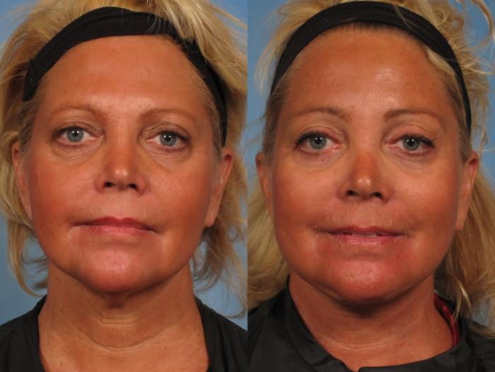 Before & After Facelift Case 166 View #3 View in Naples and Ft. Myers, FL