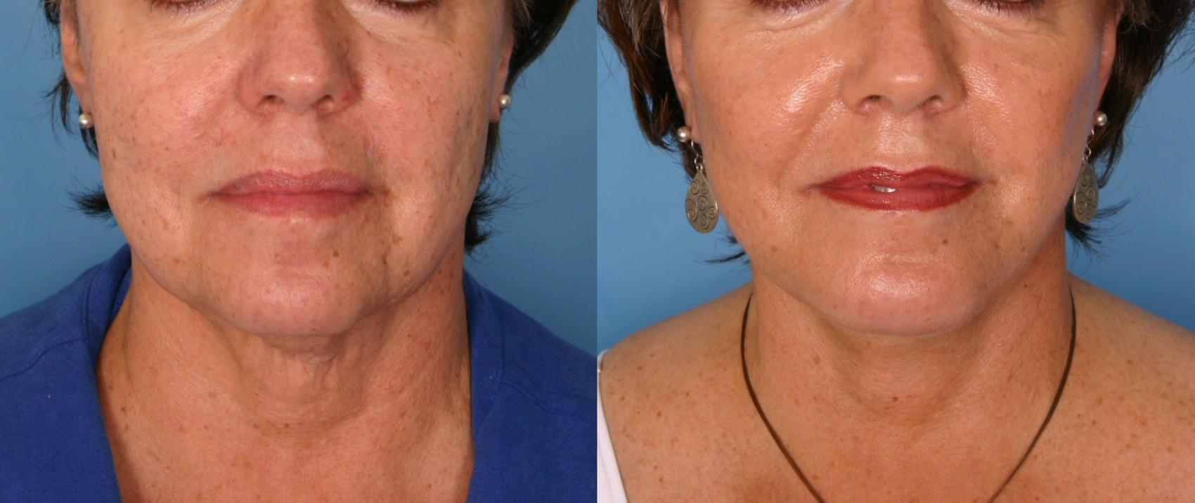 Before & After Facelift Case 179 View #1 View in Naples and Ft. Myers, FL