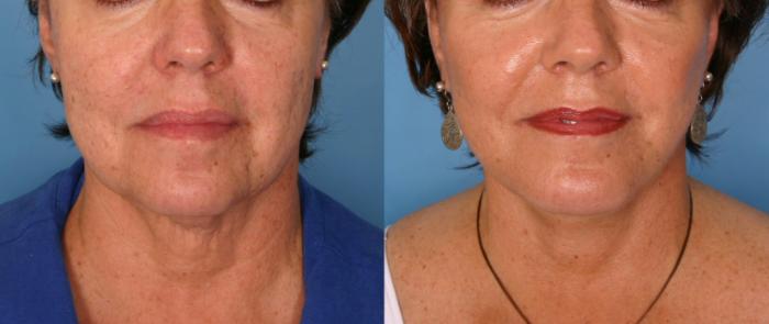Before & After Facelift Case 179 View #1 View in Naples and Ft. Myers, FL