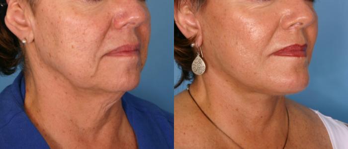 Before & After Facelift Case 179 View #2 View in Naples and Ft. Myers, FL