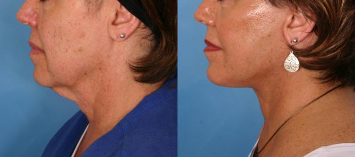 Before & After Facelift Case 179 View #3 View in Naples and Ft. Myers, FL