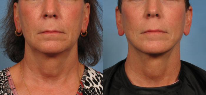 Before & After Facelift Case 180 View #1 View in Naples and Ft. Myers, FL