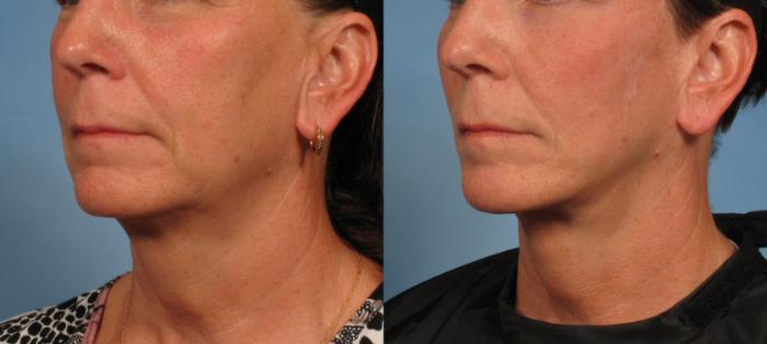 Before & After Facelift Case 180 View #2 View in Naples and Ft. Myers, FL