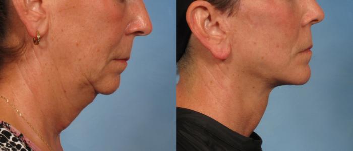 Before & After Facelift Case 180 View #3 View in Naples and Ft. Myers, FL