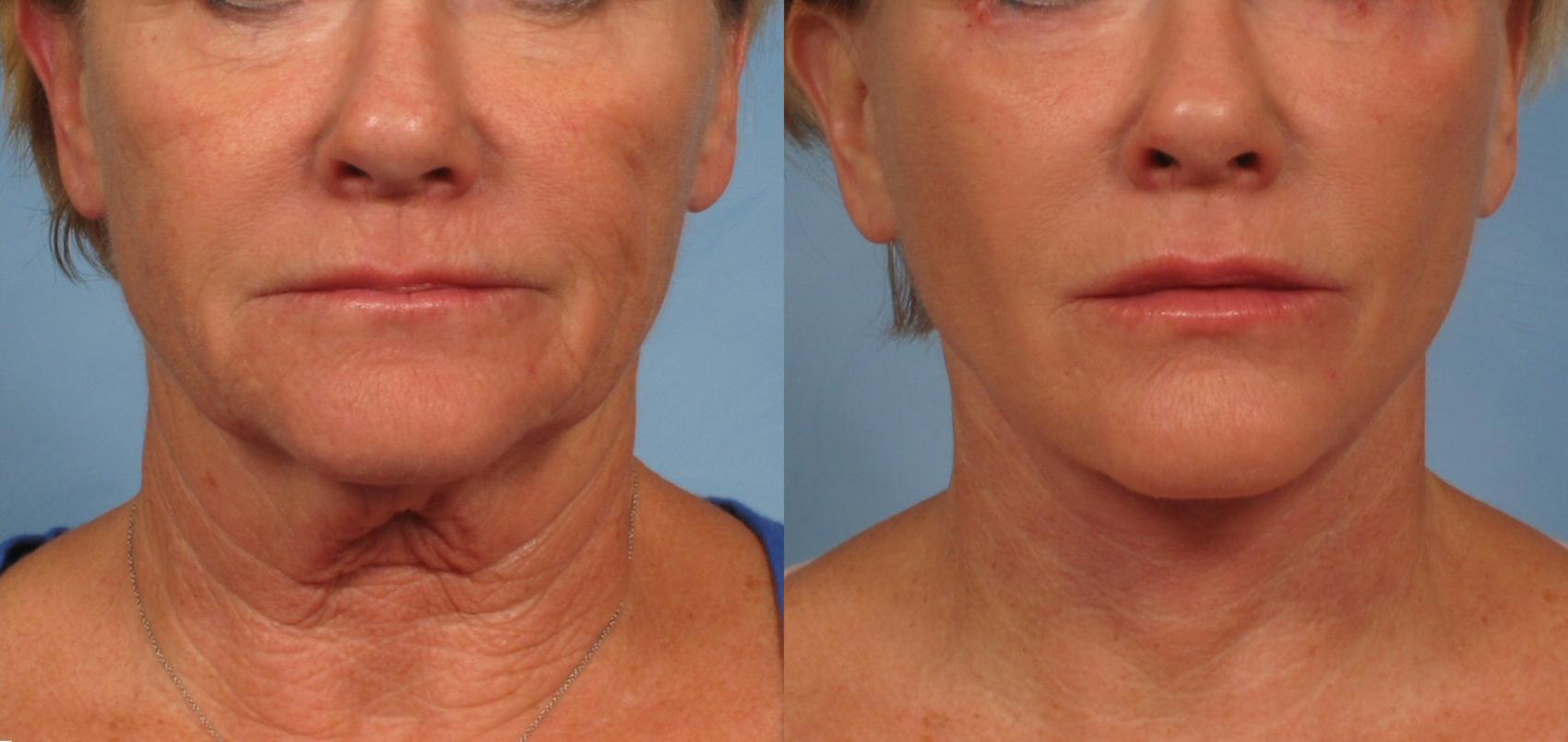 Before & After Facelift Case 181 View #1 View in Naples and Ft. Myers, FL