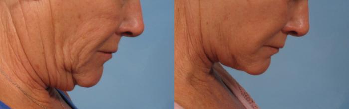 Before & After Facelift Case 181 View #3 View in Naples and Ft. Myers, FL