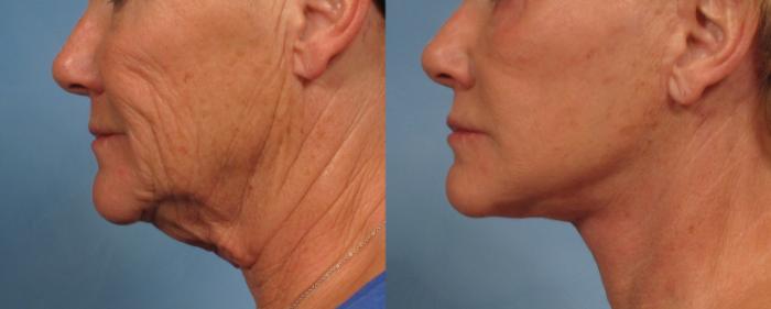 Before & After Facelift Case 181 View #4 View in Naples and Ft. Myers, FL