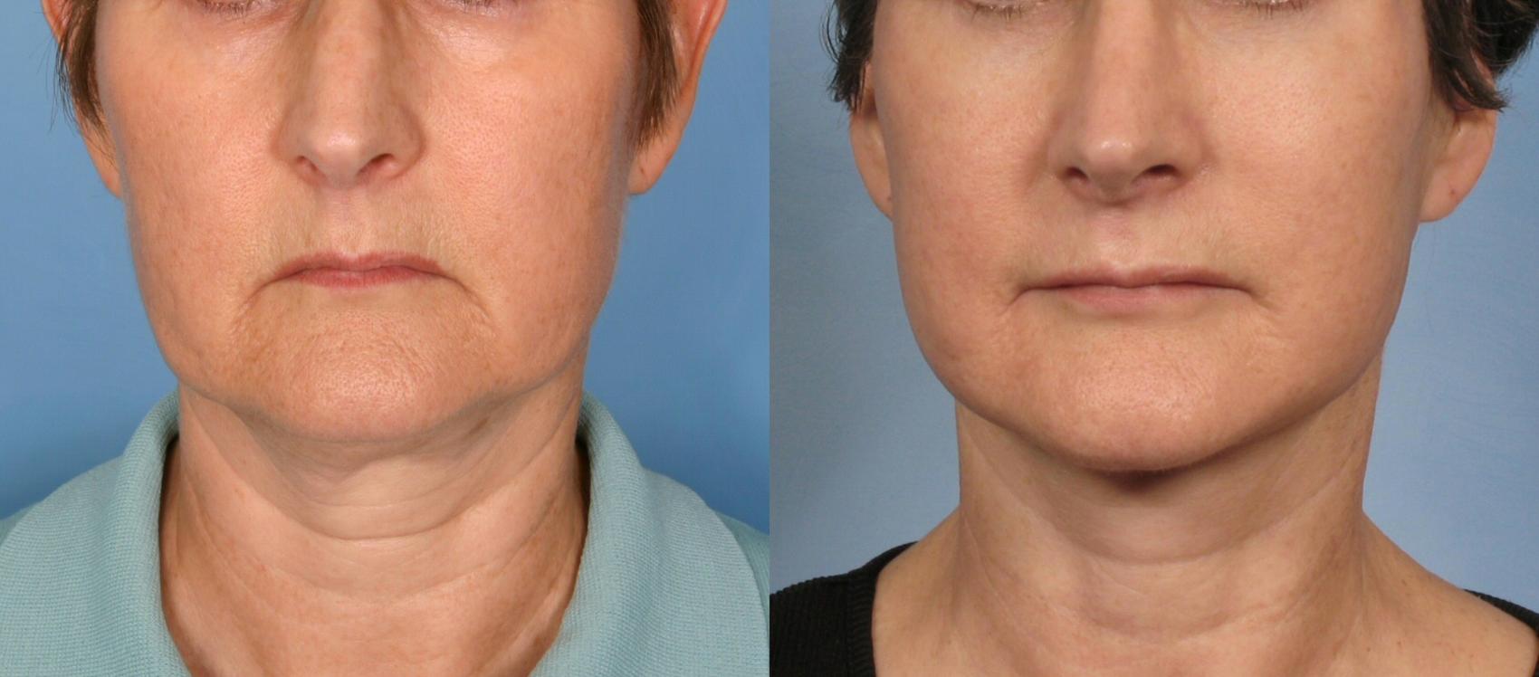Before & After Facelift Case 182 View #1 View in Naples and Ft. Myers, FL