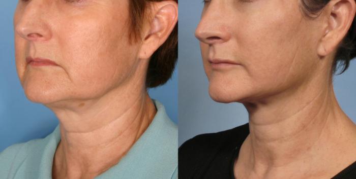 Before & After Facelift Case 182 View #2 View in Naples and Ft. Myers, FL
